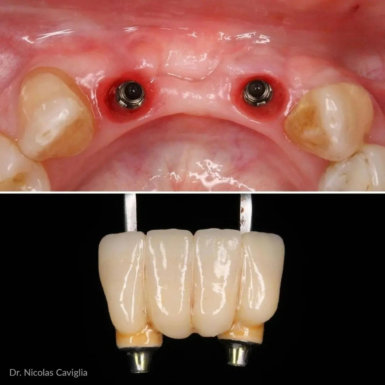 CEREC® Blue Blocks Lithium Disilicate x5