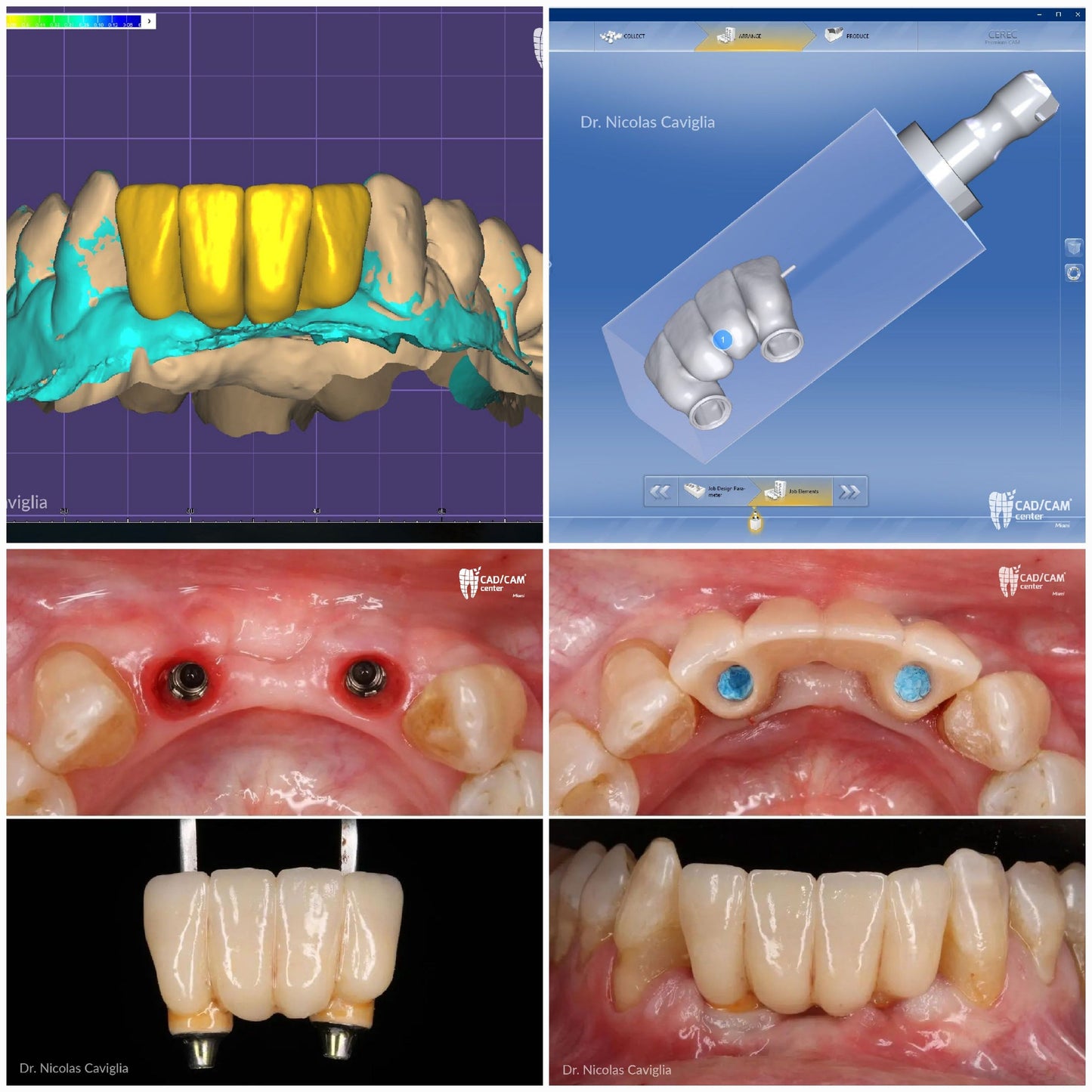 CEREC® Bridge Blocks Lithium Disilicate (e.max) B40